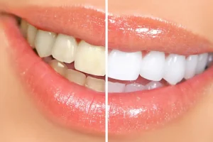 10 Blanqueamiento Dental