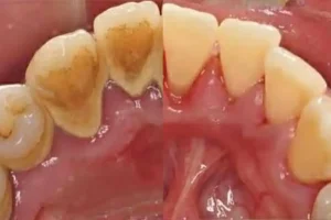 13 limpieza dental ultrasonica copia