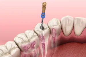 17 Endodoncia