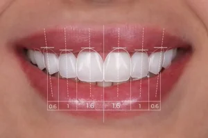 18 Diseño de Sonrisa