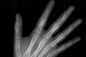 4 Radiografías Carpo copia