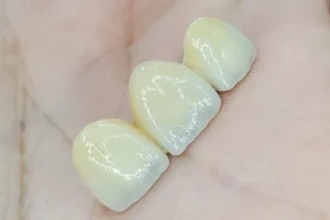 5 Prótesis Dentales fijas