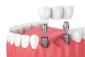 7 Implantes Dentales copia