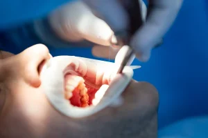 8 Extracciones Dentales copia